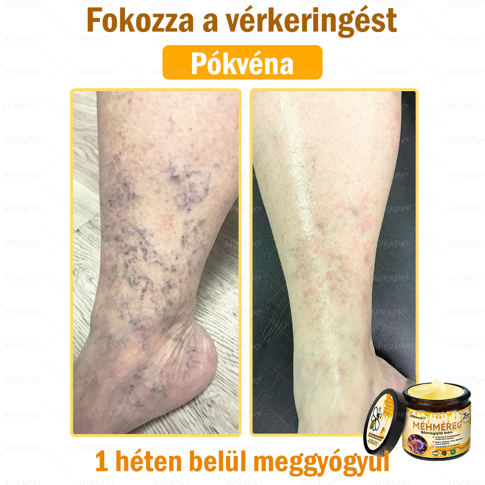 💜💜APKAPK® 𝐌É𝐇𝐌É𝐑𝐄𝐆 Á𝐓𝐅𝐎𝐆Ó 𝐊𝐑É𝐌🥇𝐀 bőrnövedékek 𝐤𝐞𝐳𝐞𝐥é𝐬𝐞 𝐦𝐚𝐠á𝐛𝐚𝐧 𝐟𝐨𝐠𝐥𝐚𝐥𝐣𝐚: é𝐥𝐞𝐭𝐤𝐨𝐫𝐢 𝐟𝐨𝐥𝐭𝐨𝐤, 𝐡𝐞𝐠𝐞𝐤, 𝐬𝐳𝐞𝐦ö𝐥𝐜𝐬ö𝐤, 𝐛ö𝐫𝐧ö𝐯𝐞𝐝é𝐤𝐞𝐤, 𝐭á𝐥𝐲𝐨𝐠𝐨𝐤, 𝐩𝐚𝐭𝐭𝐚𝐧á𝐬𝐨𝐤, 𝐞𝐤𝐜é𝐦𝐚, 𝐩𝐬𝐨𝐫𝐢𝐚𝐬𝐢𝐬, 𝐚𝐜𝐧𝐞 𝐢𝐧𝐯𝐞𝐫𝐬𝐚, 𝐫á𝐧𝐜𝐨𝐤, 𝐛ö𝐫ö𝐫𝐞𝐠𝐞𝐝é𝐬 é𝐬 𝐞𝐠𝐲é𝐛 𝐩𝐫𝐨𝐛𝐥é𝐦á𝐤🔥