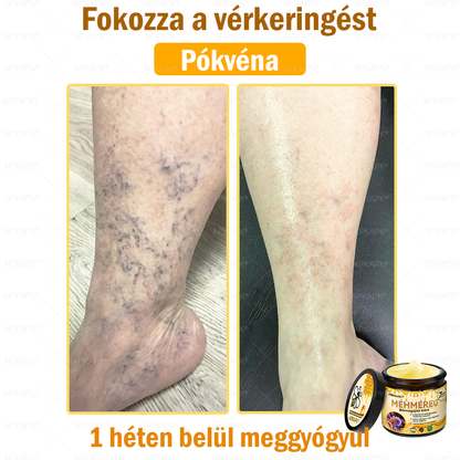 💜💜APKAPK® 𝐌É𝐇𝐌É𝐑𝐄𝐆 Á𝐓𝐅𝐎𝐆Ó 𝐊𝐑É𝐌🥇𝐀 bőrnövedékek 𝐤𝐞𝐳𝐞𝐥é𝐬𝐞 𝐦𝐚𝐠á𝐛𝐚𝐧 𝐟𝐨𝐠𝐥𝐚𝐥𝐣𝐚: é𝐥𝐞𝐭𝐤𝐨𝐫𝐢 𝐟𝐨𝐥𝐭𝐨𝐤, 𝐡𝐞𝐠𝐞𝐤, 𝐬𝐳𝐞𝐦ö𝐥𝐜𝐬ö𝐤, 𝐛ö𝐫𝐧ö𝐯𝐞𝐝é𝐤𝐞𝐤, 𝐭á𝐥𝐲𝐨𝐠𝐨𝐤, 𝐩𝐚𝐭𝐭𝐚𝐧á𝐬𝐨𝐤, 𝐞𝐤𝐜é𝐦𝐚, 𝐩𝐬𝐨𝐫𝐢𝐚𝐬𝐢𝐬, 𝐚𝐜𝐧𝐞 𝐢𝐧𝐯𝐞𝐫𝐬𝐚, 𝐫á𝐧𝐜𝐨𝐤, 𝐛ö𝐫ö𝐫𝐞𝐠𝐞𝐝é𝐬 é𝐬 𝐞𝐠𝐲é𝐛 𝐩𝐫𝐨𝐛𝐥é𝐦á𝐤🔥
