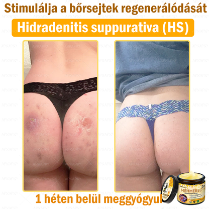 💜💜APKAPK® 𝐌É𝐇𝐌É𝐑𝐄𝐆 Á𝐓𝐅𝐎𝐆Ó 𝐊𝐑É𝐌🥇𝐀 bőrnövedékek 𝐤𝐞𝐳𝐞𝐥é𝐬𝐞 𝐦𝐚𝐠á𝐛𝐚𝐧 𝐟𝐨𝐠𝐥𝐚𝐥𝐣𝐚: é𝐥𝐞𝐭𝐤𝐨𝐫𝐢 𝐟𝐨𝐥𝐭𝐨𝐤, 𝐡𝐞𝐠𝐞𝐤, 𝐬𝐳𝐞𝐦ö𝐥𝐜𝐬ö𝐤, 𝐛ö𝐫𝐧ö𝐯𝐞𝐝é𝐤𝐞𝐤, 𝐭á𝐥𝐲𝐨𝐠𝐨𝐤, 𝐩𝐚𝐭𝐭𝐚𝐧á𝐬𝐨𝐤, 𝐞𝐤𝐜é𝐦𝐚, 𝐩𝐬𝐨𝐫𝐢𝐚𝐬𝐢𝐬, 𝐚𝐜𝐧𝐞 𝐢𝐧𝐯𝐞𝐫𝐬𝐚, 𝐫á𝐧𝐜𝐨𝐤, 𝐛ö𝐫ö𝐫𝐞𝐠𝐞𝐝é𝐬 é𝐬 𝐞𝐠𝐲é𝐛 𝐩𝐫𝐨𝐛𝐥é𝐦á𝐤🔥