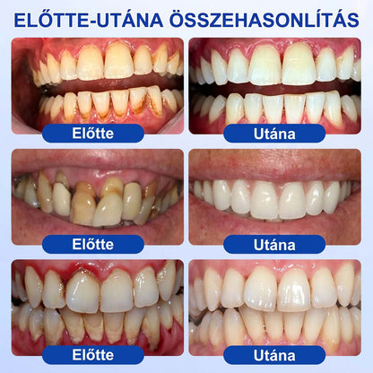PureShade® ✨ GumRevive Ínyregeneráló Gél – Az egészségesebb ínyért és magabiztosabb mosolyért 👍