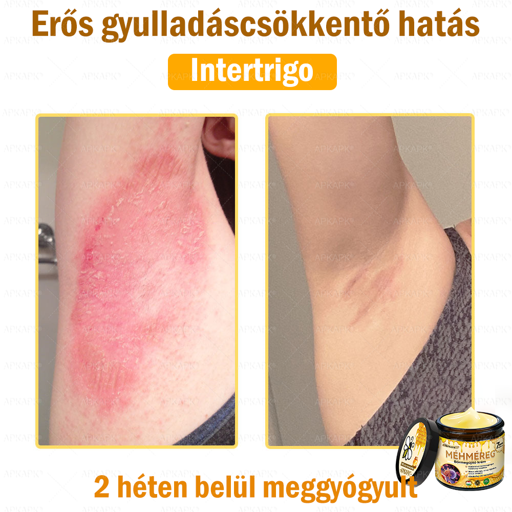 💜💜APKAPK® 𝐌É𝐇𝐌É𝐑𝐄𝐆 Á𝐓𝐅𝐎𝐆Ó 𝐊𝐑É𝐌🥇𝐀 bőrnövedékek 𝐤𝐞𝐳𝐞𝐥é𝐬𝐞 𝐦𝐚𝐠á𝐛𝐚𝐧 𝐟𝐨𝐠𝐥𝐚𝐥𝐣𝐚: é𝐥𝐞𝐭𝐤𝐨𝐫𝐢 𝐟𝐨𝐥𝐭𝐨𝐤, 𝐡𝐞𝐠𝐞𝐤, 𝐬𝐳𝐞𝐦ö𝐥𝐜𝐬ö𝐤, 𝐛ö𝐫𝐧ö𝐯𝐞𝐝é𝐤𝐞𝐤, 𝐭á𝐥𝐲𝐨𝐠𝐨𝐤, 𝐩𝐚𝐭𝐭𝐚𝐧á𝐬𝐨𝐤, 𝐞𝐤𝐜é𝐦𝐚, 𝐩𝐬𝐨𝐫𝐢𝐚𝐬𝐢𝐬, 𝐚𝐜𝐧𝐞 𝐢𝐧𝐯𝐞𝐫𝐬𝐚, 𝐫á𝐧𝐜𝐨𝐤, 𝐛ö𝐫ö𝐫𝐞𝐠𝐞𝐝é𝐬 é𝐬 𝐞𝐠𝐲é𝐛 𝐩𝐫𝐨𝐛𝐥é𝐦á𝐤🔥
