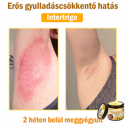 💜💜APKAPK® 𝐌É𝐇𝐌É𝐑𝐄𝐆 Á𝐓𝐅𝐎𝐆Ó 𝐊𝐑É𝐌🥇𝐀 bőrnövedékek 𝐤𝐞𝐳𝐞𝐥é𝐬𝐞 𝐦𝐚𝐠á𝐛𝐚𝐧 𝐟𝐨𝐠𝐥𝐚𝐥𝐣𝐚: é𝐥𝐞𝐭𝐤𝐨𝐫𝐢 𝐟𝐨𝐥𝐭𝐨𝐤, 𝐡𝐞𝐠𝐞𝐤, 𝐬𝐳𝐞𝐦ö𝐥𝐜𝐬ö𝐤, 𝐛ö𝐫𝐧ö𝐯𝐞𝐝é𝐤𝐞𝐤, 𝐭á𝐥𝐲𝐨𝐠𝐨𝐤, 𝐩𝐚𝐭𝐭𝐚𝐧á𝐬𝐨𝐤, 𝐞𝐤𝐜é𝐦𝐚, 𝐩𝐬𝐨𝐫𝐢𝐚𝐬𝐢𝐬, 𝐚𝐜𝐧𝐞 𝐢𝐧𝐯𝐞𝐫𝐬𝐚, 𝐫á𝐧𝐜𝐨𝐤, 𝐛ö𝐫ö𝐫𝐞𝐠𝐞𝐝é𝐬 é𝐬 𝐞𝐠𝐲é𝐛 𝐩𝐫𝐨𝐛𝐥é𝐦á𝐤🔥