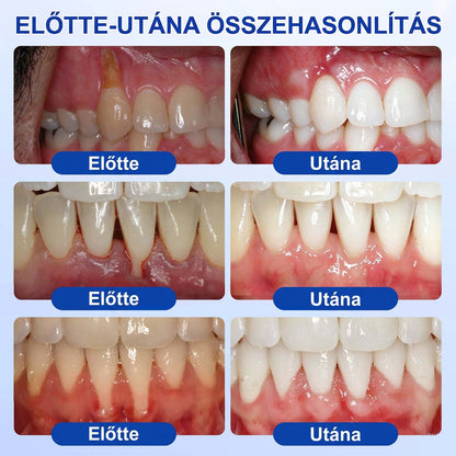 PureShade® ✨ GumRevive Ínyregeneráló Gél – Az egészségesebb ínyért és magabiztosabb mosolyért 👍