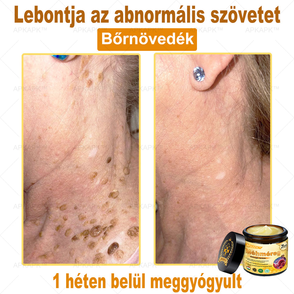 🐝🐝🐝APKAPK® Méhméreg Átfogó Krém🔥 Magyar fejlesztés, magyarországi gyártás és szállítás