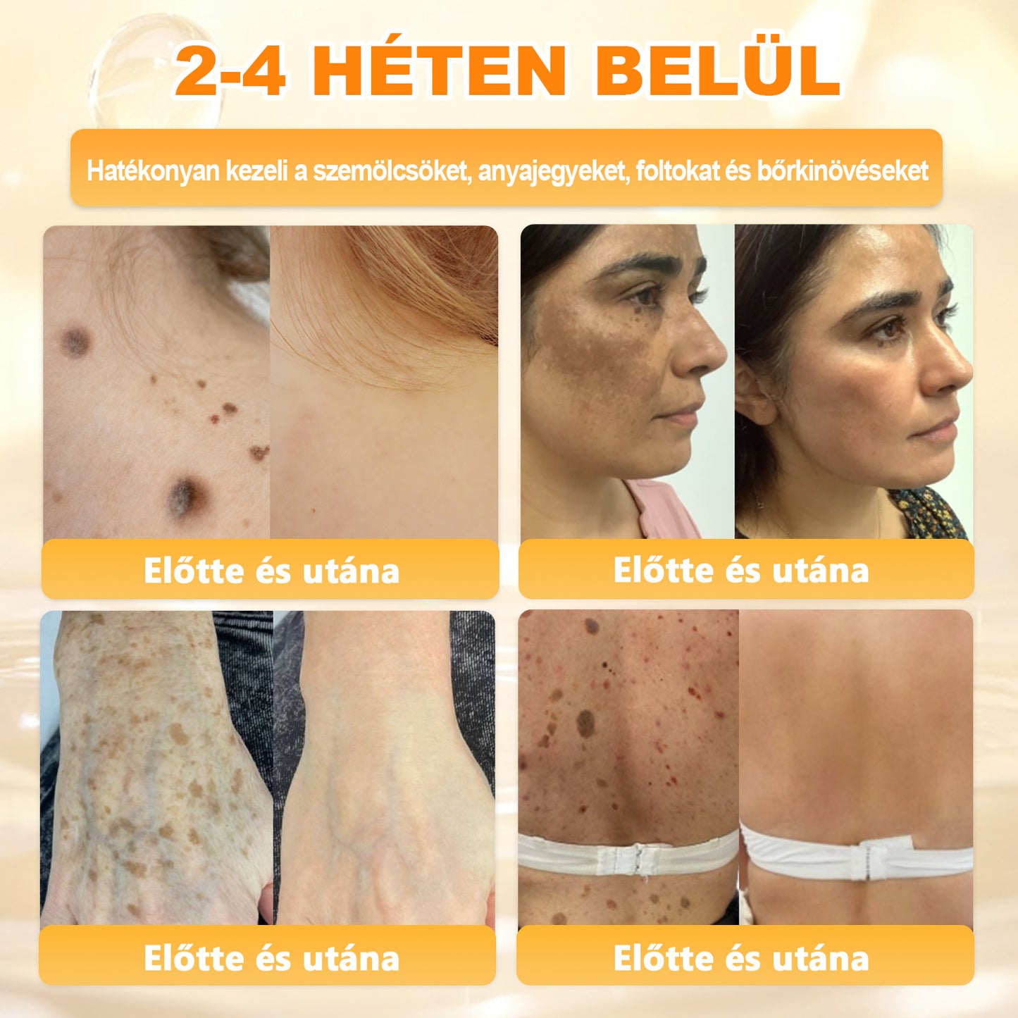 💜APKAPK® 𝐌É𝐇𝐌É𝐑𝐄𝐆 Á𝐓𝐅𝐎𝐆Ó 𝐊𝐑É𝐌🥇🥇🥇𝐀 bőrnövedékek 𝐤𝐞𝐳𝐞𝐥é𝐬𝐞 𝐦𝐚𝐠á𝐛𝐚𝐧 𝐟𝐨𝐠𝐥𝐚𝐥𝐣𝐚: é𝐥𝐞𝐭𝐤𝐨𝐫𝐢 𝐟𝐨𝐥𝐭𝐨𝐤, 𝐡𝐞𝐠𝐞𝐤, 𝐬𝐳𝐞𝐦ö𝐥𝐜𝐬ö𝐤, 𝐛ö𝐫𝐧ö𝐯𝐞𝐝é𝐤𝐞𝐤, 𝐭á𝐥𝐲𝐨𝐠𝐨𝐤, 𝐩𝐚𝐭𝐭𝐚𝐧á𝐬𝐨𝐤, 𝐞𝐤𝐜é𝐦𝐚, 𝐩𝐬𝐨𝐫𝐢𝐚𝐬𝐢𝐬, 𝐚𝐜𝐧𝐞 𝐢𝐧𝐯𝐞𝐫𝐬𝐚, 𝐫á𝐧𝐜𝐨𝐤, 𝐛ö𝐫ö𝐫𝐞𝐠𝐞𝐝é𝐬 é𝐬 𝐞𝐠𝐲é𝐛 𝐩𝐫𝐨𝐛𝐥é𝐦á𝐤🔥