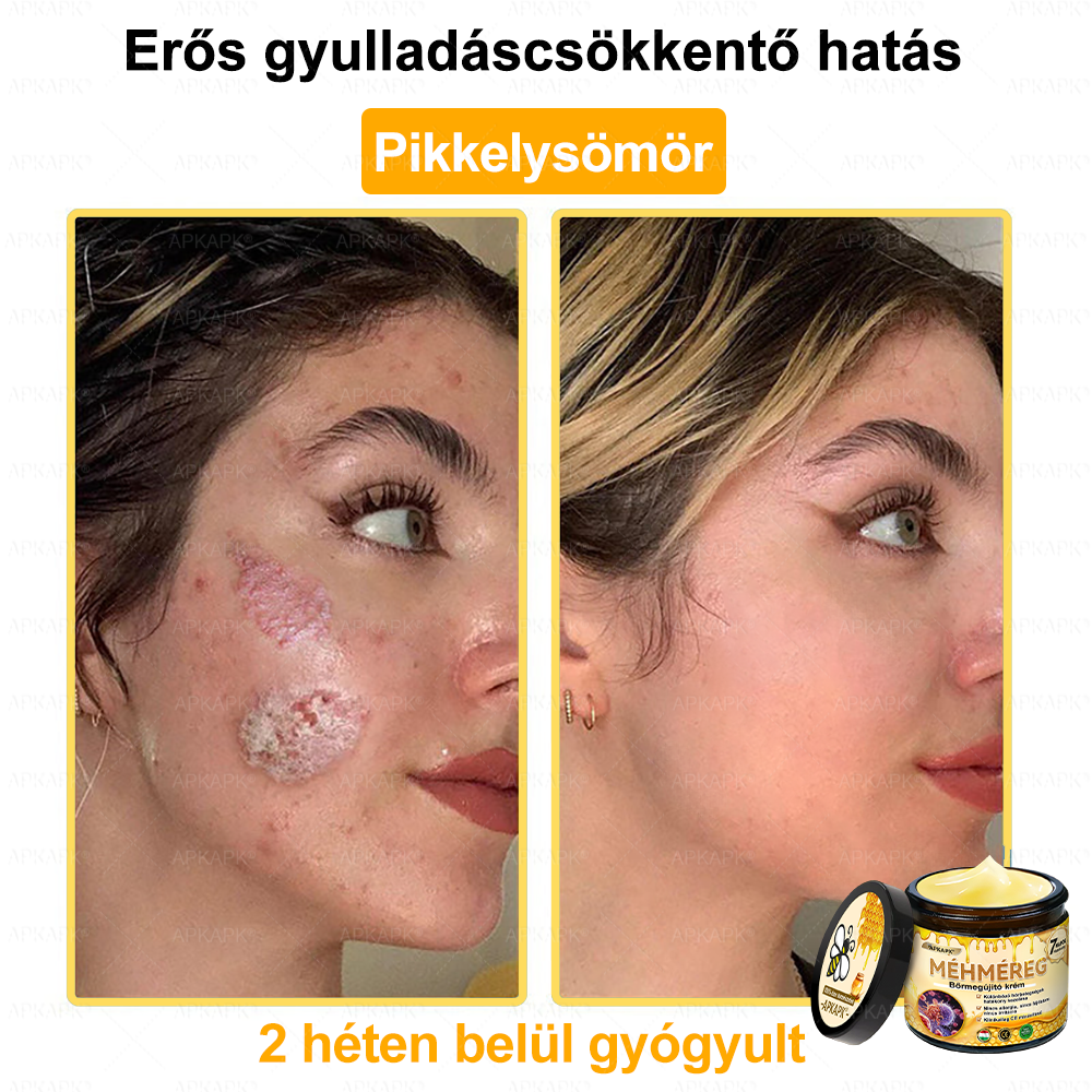 💜💜APKAPK® 𝐌É𝐇𝐌É𝐑𝐄𝐆 Á𝐓𝐅𝐎𝐆Ó 𝐊𝐑É𝐌🥇𝐀 bőrnövedékek 𝐤𝐞𝐳𝐞𝐥é𝐬𝐞 𝐦𝐚𝐠á𝐛𝐚𝐧 𝐟𝐨𝐠𝐥𝐚𝐥𝐣𝐚: é𝐥𝐞𝐭𝐤𝐨𝐫𝐢 𝐟𝐨𝐥𝐭𝐨𝐤, 𝐡𝐞𝐠𝐞𝐤, 𝐬𝐳𝐞𝐦ö𝐥𝐜𝐬ö𝐤, 𝐛ö𝐫𝐧ö𝐯𝐞𝐝é𝐤𝐞𝐤, 𝐭á𝐥𝐲𝐨𝐠𝐨𝐤, 𝐩𝐚𝐭𝐭𝐚𝐧á𝐬𝐨𝐤, 𝐞𝐤𝐜é𝐦𝐚, 𝐩𝐬𝐨𝐫𝐢𝐚𝐬𝐢𝐬, 𝐚𝐜𝐧𝐞 𝐢𝐧𝐯𝐞𝐫𝐬𝐚, 𝐫á𝐧𝐜𝐨𝐤, 𝐛ö𝐫ö𝐫𝐞𝐠𝐞𝐝é𝐬 é𝐬 𝐞𝐠𝐲é𝐛 𝐩𝐫𝐨𝐛𝐥é𝐦á𝐤🔥