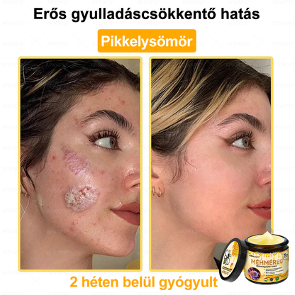 💜💜APKAPK® 𝐌É𝐇𝐌É𝐑𝐄𝐆 Á𝐓𝐅𝐎𝐆Ó 𝐊𝐑É𝐌🥇𝐀 bőrnövedékek 𝐤𝐞𝐳𝐞𝐥é𝐬𝐞 𝐦𝐚𝐠á𝐛𝐚𝐧 𝐟𝐨𝐠𝐥𝐚𝐥𝐣𝐚: é𝐥𝐞𝐭𝐤𝐨𝐫𝐢 𝐟𝐨𝐥𝐭𝐨𝐤, 𝐡𝐞𝐠𝐞𝐤, 𝐬𝐳𝐞𝐦ö𝐥𝐜𝐬ö𝐤, 𝐛ö𝐫𝐧ö𝐯𝐞𝐝é𝐤𝐞𝐤, 𝐭á𝐥𝐲𝐨𝐠𝐨𝐤, 𝐩𝐚𝐭𝐭𝐚𝐧á𝐬𝐨𝐤, 𝐞𝐤𝐜é𝐦𝐚, 𝐩𝐬𝐨𝐫𝐢𝐚𝐬𝐢𝐬, 𝐚𝐜𝐧𝐞 𝐢𝐧𝐯𝐞𝐫𝐬𝐚, 𝐫á𝐧𝐜𝐨𝐤, 𝐛ö𝐫ö𝐫𝐞𝐠𝐞𝐝é𝐬 é𝐬 𝐞𝐠𝐲é𝐛 𝐩𝐫𝐨𝐛𝐥é𝐦á𝐤🔥