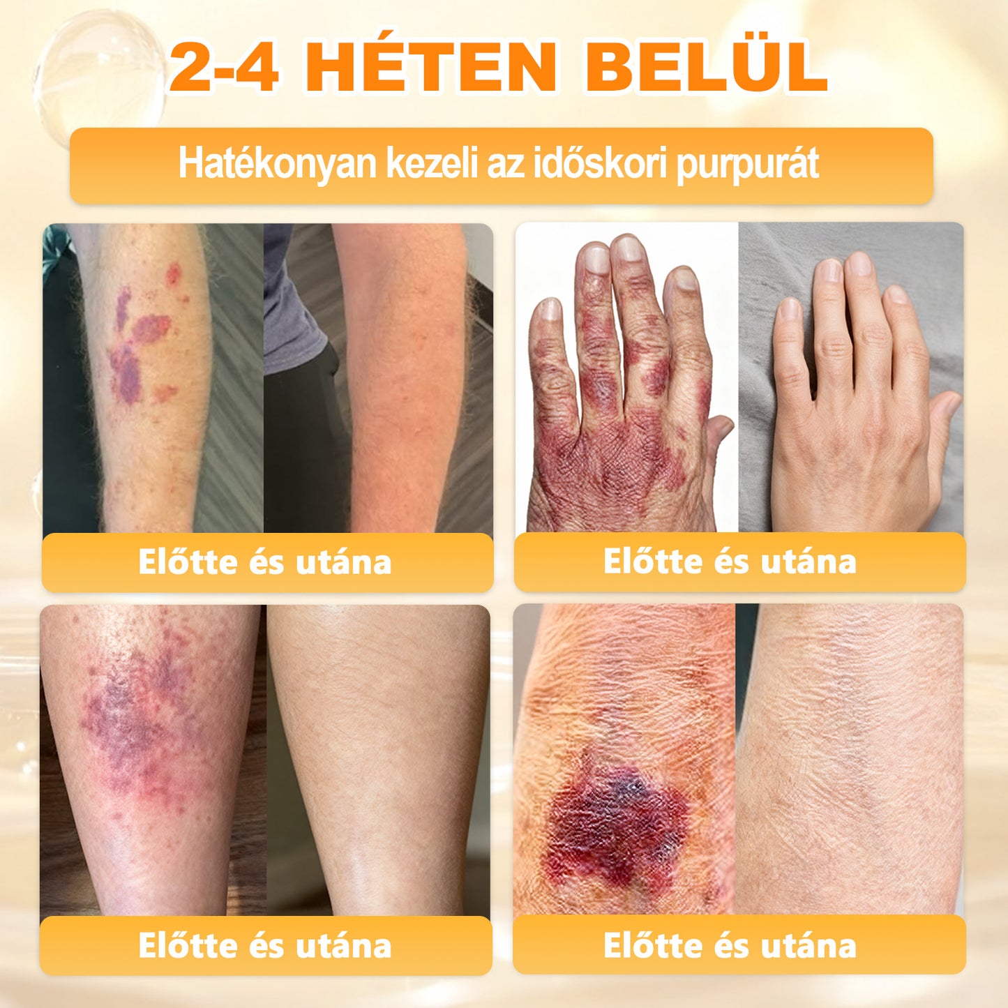 💜APKAPK® 𝐌É𝐇𝐌É𝐑𝐄𝐆 Á𝐓𝐅𝐎𝐆Ó 𝐊𝐑É𝐌🥇🥇🥇𝐀 bőrnövedékek 𝐤𝐞𝐳𝐞𝐥é𝐬𝐞 𝐦𝐚𝐠á𝐛𝐚𝐧 𝐟𝐨𝐠𝐥𝐚𝐥𝐣𝐚: é𝐥𝐞𝐭𝐤𝐨𝐫𝐢 𝐟𝐨𝐥𝐭𝐨𝐤, 𝐡𝐞𝐠𝐞𝐤, 𝐬𝐳𝐞𝐦ö𝐥𝐜𝐬ö𝐤, 𝐛ö𝐫𝐧ö𝐯𝐞𝐝é𝐤𝐞𝐤, 𝐭á𝐥𝐲𝐨𝐠𝐨𝐤, 𝐩𝐚𝐭𝐭𝐚𝐧á𝐬𝐨𝐤, 𝐞𝐤𝐜é𝐦𝐚, 𝐩𝐬𝐨𝐫𝐢𝐚𝐬𝐢𝐬, 𝐚𝐜𝐧𝐞 𝐢𝐧𝐯𝐞𝐫𝐬𝐚, 𝐫á𝐧𝐜𝐨𝐤, 𝐛ö𝐫ö𝐫𝐞𝐠𝐞𝐝é𝐬 é𝐬 𝐞𝐠𝐲é𝐛 𝐩𝐫𝐨𝐛𝐥é𝐦á𝐤🔥