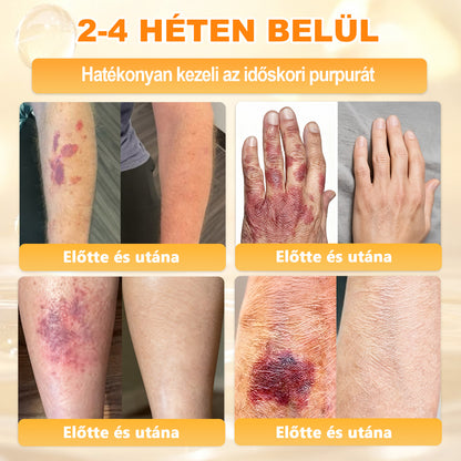 💜APKAPK® 𝐌É𝐇𝐌É𝐑𝐄𝐆 Á𝐓𝐅𝐎𝐆Ó 𝐊𝐑É𝐌🥇🥇🥇𝐀 bőrnövedékek 𝐤𝐞𝐳𝐞𝐥é𝐬𝐞 𝐦𝐚𝐠á𝐛𝐚𝐧 𝐟𝐨𝐠𝐥𝐚𝐥𝐣𝐚: é𝐥𝐞𝐭𝐤𝐨𝐫𝐢 𝐟𝐨𝐥𝐭𝐨𝐤, 𝐡𝐞𝐠𝐞𝐤, 𝐬𝐳𝐞𝐦ö𝐥𝐜𝐬ö𝐤, 𝐛ö𝐫𝐧ö𝐯𝐞𝐝é𝐤𝐞𝐤, 𝐭á𝐥𝐲𝐨𝐠𝐨𝐤, 𝐩𝐚𝐭𝐭𝐚𝐧á𝐬𝐨𝐤, 𝐞𝐤𝐜é𝐦𝐚, 𝐩𝐬𝐨𝐫𝐢𝐚𝐬𝐢𝐬, 𝐚𝐜𝐧𝐞 𝐢𝐧𝐯𝐞𝐫𝐬𝐚, 𝐫á𝐧𝐜𝐨𝐤, 𝐛ö𝐫ö𝐫𝐞𝐠𝐞𝐝é𝐬 é𝐬 𝐞𝐠𝐲é𝐛 𝐩𝐫𝐨𝐛𝐥é𝐦á𝐤🔥