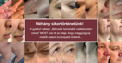 PURESHADE® 2 az 1-ben mikrotűs és hidrokolloid tapasz🍀🍀 | Kiálló anyajegyek, aknék, lapos szemölcsök és bőrnövedékek eltávolítására | Segít csökkenteni a ráncokat, hegeket és bőrhibákat | Láthatatlan tapasz az arcra és testre