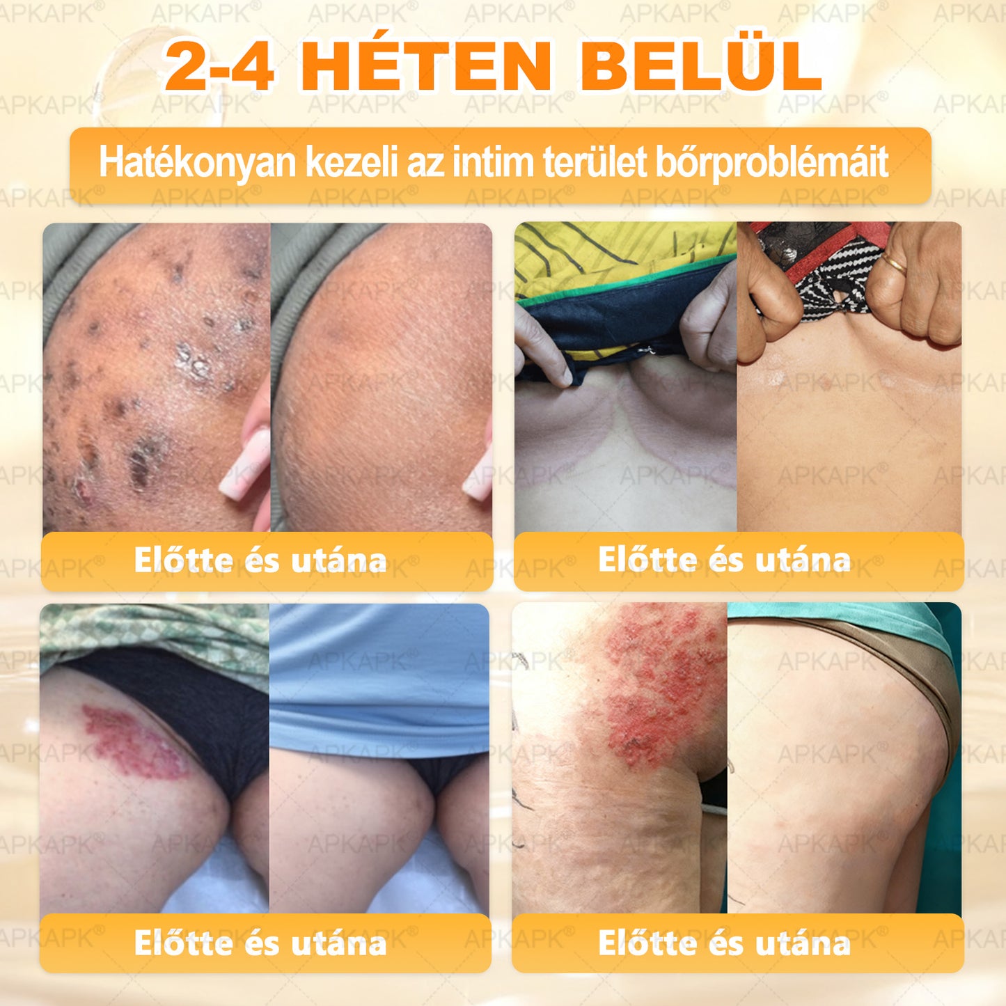 💜APKAPK® 𝐌É𝐇𝐌É𝐑𝐄𝐆 Á𝐓𝐅𝐎𝐆Ó 𝐊𝐑É𝐌🥇🥇🥇𝐀 bőrnövedékek 𝐤𝐞𝐳𝐞𝐥é𝐬𝐞 𝐦𝐚𝐠á𝐛𝐚𝐧 𝐟𝐨𝐠𝐥𝐚𝐥𝐣𝐚: é𝐥𝐞𝐭𝐤𝐨𝐫𝐢 𝐟𝐨𝐥𝐭𝐨𝐤, 𝐡𝐞𝐠𝐞𝐤, 𝐬𝐳𝐞𝐦ö𝐥𝐜𝐬ö𝐤, 𝐛ö𝐫𝐧ö𝐯𝐞𝐝é𝐤𝐞𝐤, 𝐭á𝐥𝐲𝐨𝐠𝐨𝐤, 𝐩𝐚𝐭𝐭𝐚𝐧á𝐬𝐨𝐤, 𝐞𝐤𝐜é𝐦𝐚, 𝐩𝐬𝐨𝐫𝐢𝐚𝐬𝐢𝐬, 𝐚𝐜𝐧𝐞 𝐢𝐧𝐯𝐞𝐫𝐬𝐚, 𝐫á𝐧𝐜𝐨𝐤, 𝐛ö𝐫ö𝐫𝐞𝐠𝐞𝐝é𝐬 é𝐬 𝐞𝐠𝐲é𝐛 𝐩𝐫𝐨𝐛𝐥é𝐦á𝐤🔥