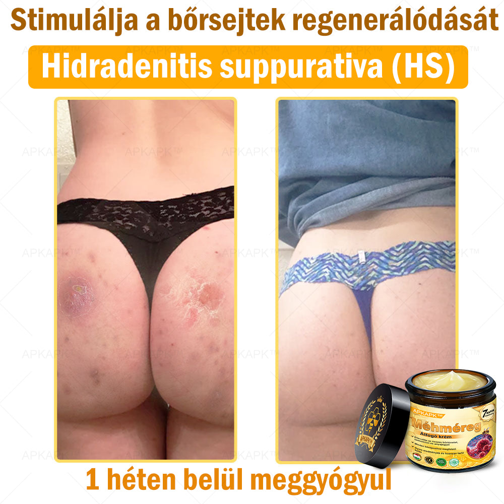 🐝🐝🐝APKAPK® Méhméreg Átfogó Krém🔥 Magyar fejlesztés, magyarországi gyártás és szállítás