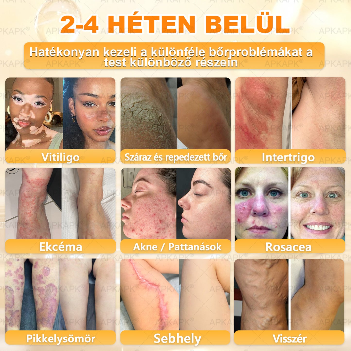 💜APKAPK® 𝐌É𝐇𝐌É𝐑𝐄𝐆 Á𝐓𝐅𝐎𝐆Ó 𝐊𝐑É𝐌🥇🥇🥇𝐀 bőrnövedékek 𝐤𝐞𝐳𝐞𝐥é𝐬𝐞 𝐦𝐚𝐠á𝐛𝐚𝐧 𝐟𝐨𝐠𝐥𝐚𝐥𝐣𝐚: é𝐥𝐞𝐭𝐤𝐨𝐫𝐢 𝐟𝐨𝐥𝐭𝐨𝐤, 𝐡𝐞𝐠𝐞𝐤, 𝐬𝐳𝐞𝐦ö𝐥𝐜𝐬ö𝐤, 𝐛ö𝐫𝐧ö𝐯𝐞𝐝é𝐤𝐞𝐤, 𝐭á𝐥𝐲𝐨𝐠𝐨𝐤, 𝐩𝐚𝐭𝐭𝐚𝐧á𝐬𝐨𝐤, 𝐞𝐤𝐜é𝐦𝐚, 𝐩𝐬𝐨𝐫𝐢𝐚𝐬𝐢𝐬, 𝐚𝐜𝐧𝐞 𝐢𝐧𝐯𝐞𝐫𝐬𝐚, 𝐫á𝐧𝐜𝐨𝐤, 𝐛ö𝐫ö𝐫𝐞𝐠𝐞𝐝é𝐬 é𝐬 𝐞𝐠𝐲é𝐛 𝐩𝐫𝐨𝐛𝐥é𝐦á𝐤🔥