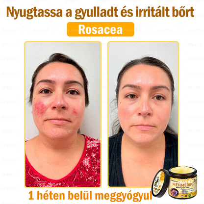 💜💜APKAPK® 𝐌É𝐇𝐌É𝐑𝐄𝐆 Á𝐓𝐅𝐎𝐆Ó 𝐊𝐑É𝐌🥇𝐀 bőrnövedékek 𝐤𝐞𝐳𝐞𝐥é𝐬𝐞 𝐦𝐚𝐠á𝐛𝐚𝐧 𝐟𝐨𝐠𝐥𝐚𝐥𝐣𝐚: é𝐥𝐞𝐭𝐤𝐨𝐫𝐢 𝐟𝐨𝐥𝐭𝐨𝐤, 𝐡𝐞𝐠𝐞𝐤, 𝐬𝐳𝐞𝐦ö𝐥𝐜𝐬ö𝐤, 𝐛ö𝐫𝐧ö𝐯𝐞𝐝é𝐤𝐞𝐤, 𝐭á𝐥𝐲𝐨𝐠𝐨𝐤, 𝐩𝐚𝐭𝐭𝐚𝐧á𝐬𝐨𝐤, 𝐞𝐤𝐜é𝐦𝐚, 𝐩𝐬𝐨𝐫𝐢𝐚𝐬𝐢𝐬, 𝐚𝐜𝐧𝐞 𝐢𝐧𝐯𝐞𝐫𝐬𝐚, 𝐫á𝐧𝐜𝐨𝐤, 𝐛ö𝐫ö𝐫𝐞𝐠𝐞𝐝é𝐬 é𝐬 𝐞𝐠𝐲é𝐛 𝐩𝐫𝐨𝐛𝐥é𝐦á𝐤🔥