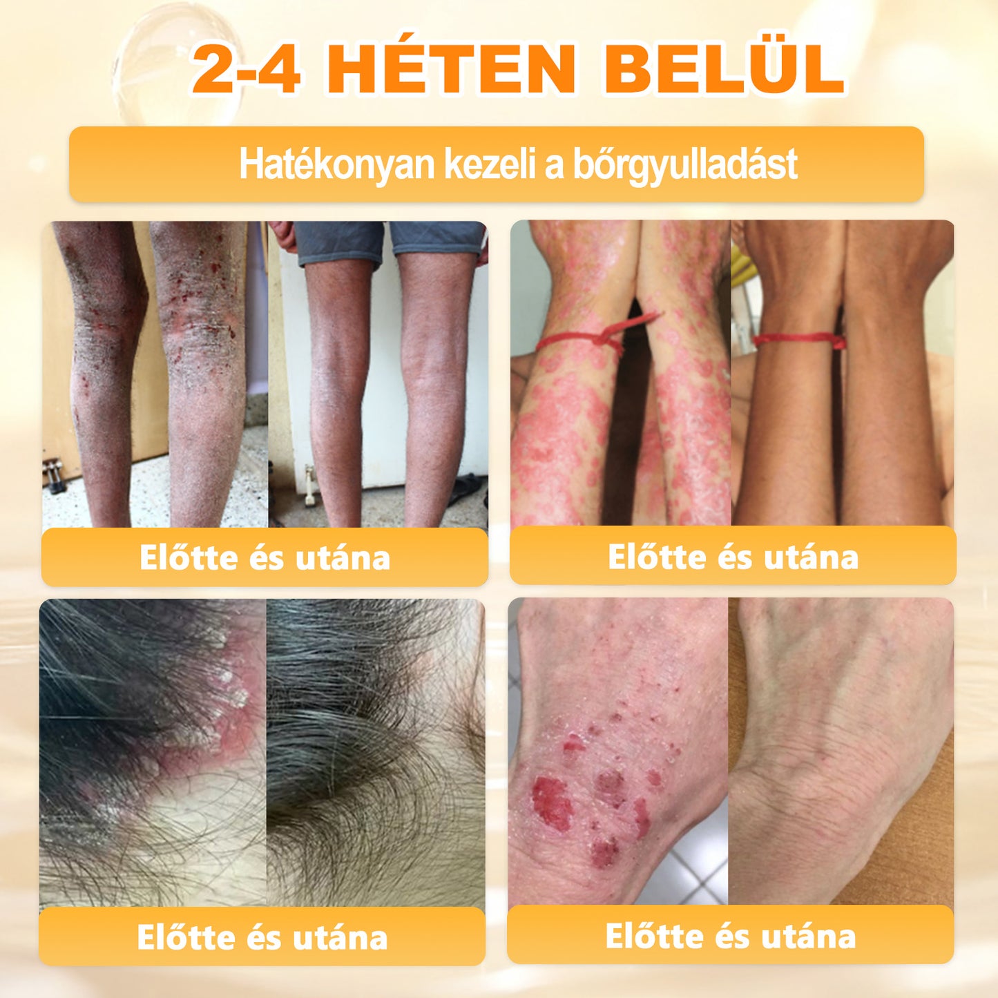 💜APKAPK® 𝐌É𝐇𝐌É𝐑𝐄𝐆 Á𝐓𝐅𝐎𝐆Ó 𝐊𝐑É𝐌🥇🥇🥇𝐀 bőrnövedékek 𝐤𝐞𝐳𝐞𝐥é𝐬𝐞 𝐦𝐚𝐠á𝐛𝐚𝐧 𝐟𝐨𝐠𝐥𝐚𝐥𝐣𝐚: é𝐥𝐞𝐭𝐤𝐨𝐫𝐢 𝐟𝐨𝐥𝐭𝐨𝐤, 𝐡𝐞𝐠𝐞𝐤, 𝐬𝐳𝐞𝐦ö𝐥𝐜𝐬ö𝐤, 𝐛ö𝐫𝐧ö𝐯𝐞𝐝é𝐤𝐞𝐤, 𝐭á𝐥𝐲𝐨𝐠𝐨𝐤, 𝐩𝐚𝐭𝐭𝐚𝐧á𝐬𝐨𝐤, 𝐞𝐤𝐜é𝐦𝐚, 𝐩𝐬𝐨𝐫𝐢𝐚𝐬𝐢𝐬, 𝐚𝐜𝐧𝐞 𝐢𝐧𝐯𝐞𝐫𝐬𝐚, 𝐫á𝐧𝐜𝐨𝐤, 𝐛ö𝐫ö𝐫𝐞𝐠𝐞𝐝é𝐬 é𝐬 𝐞𝐠𝐲é𝐛 𝐩𝐫𝐨𝐛𝐥é𝐦á𝐤🔥