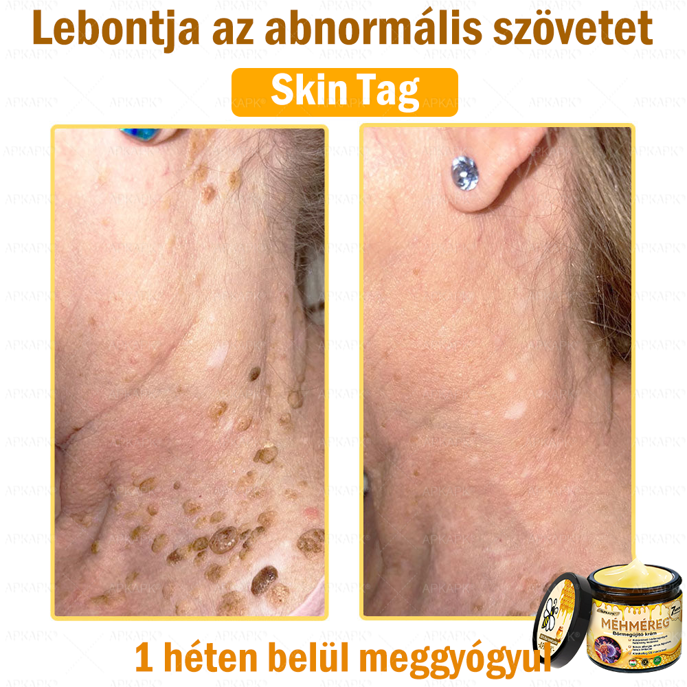 💜💜APKAPK® 𝐌É𝐇𝐌É𝐑𝐄𝐆 Á𝐓𝐅𝐎𝐆Ó 𝐊𝐑É𝐌🥇𝐀 bőrnövedékek 𝐤𝐞𝐳𝐞𝐥é𝐬𝐞 𝐦𝐚𝐠á𝐛𝐚𝐧 𝐟𝐨𝐠𝐥𝐚𝐥𝐣𝐚: é𝐥𝐞𝐭𝐤𝐨𝐫𝐢 𝐟𝐨𝐥𝐭𝐨𝐤, 𝐡𝐞𝐠𝐞𝐤, 𝐬𝐳𝐞𝐦ö𝐥𝐜𝐬ö𝐤, 𝐛ö𝐫𝐧ö𝐯𝐞𝐝é𝐤𝐞𝐤, 𝐭á𝐥𝐲𝐨𝐠𝐨𝐤, 𝐩𝐚𝐭𝐭𝐚𝐧á𝐬𝐨𝐤, 𝐞𝐤𝐜é𝐦𝐚, 𝐩𝐬𝐨𝐫𝐢𝐚𝐬𝐢𝐬, 𝐚𝐜𝐧𝐞 𝐢𝐧𝐯𝐞𝐫𝐬𝐚, 𝐫á𝐧𝐜𝐨𝐤, 𝐛ö𝐫ö𝐫𝐞𝐠𝐞𝐝é𝐬 é𝐬 𝐞𝐠𝐲é𝐛 𝐩𝐫𝐨𝐛𝐥é𝐦á𝐤🔥