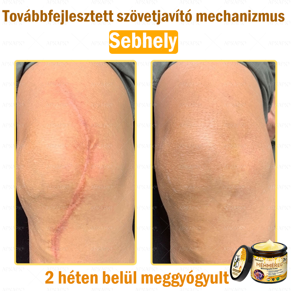 💜💜APKAPK® 𝐌É𝐇𝐌É𝐑𝐄𝐆 Á𝐓𝐅𝐎𝐆Ó 𝐊𝐑É𝐌🥇𝐀 bőrnövedékek 𝐤𝐞𝐳𝐞𝐥é𝐬𝐞 𝐦𝐚𝐠á𝐛𝐚𝐧 𝐟𝐨𝐠𝐥𝐚𝐥𝐣𝐚: é𝐥𝐞𝐭𝐤𝐨𝐫𝐢 𝐟𝐨𝐥𝐭𝐨𝐤, 𝐡𝐞𝐠𝐞𝐤, 𝐬𝐳𝐞𝐦ö𝐥𝐜𝐬ö𝐤, 𝐛ö𝐫𝐧ö𝐯𝐞𝐝é𝐤𝐞𝐤, 𝐭á𝐥𝐲𝐨𝐠𝐨𝐤, 𝐩𝐚𝐭𝐭𝐚𝐧á𝐬𝐨𝐤, 𝐞𝐤𝐜é𝐦𝐚, 𝐩𝐬𝐨𝐫𝐢𝐚𝐬𝐢𝐬, 𝐚𝐜𝐧𝐞 𝐢𝐧𝐯𝐞𝐫𝐬𝐚, 𝐫á𝐧𝐜𝐨𝐤, 𝐛ö𝐫ö𝐫𝐞𝐠𝐞𝐝é𝐬 é𝐬 𝐞𝐠𝐲é𝐛 𝐩𝐫𝐨𝐛𝐥é𝐦á𝐤🔥