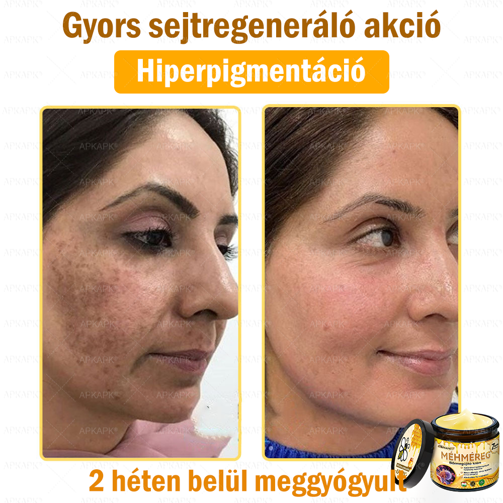 💜💜APKAPK® 𝐌É𝐇𝐌É𝐑𝐄𝐆 Á𝐓𝐅𝐎𝐆Ó 𝐊𝐑É𝐌🥇𝐀 bőrnövedékek 𝐤𝐞𝐳𝐞𝐥é𝐬𝐞 𝐦𝐚𝐠á𝐛𝐚𝐧 𝐟𝐨𝐠𝐥𝐚𝐥𝐣𝐚: é𝐥𝐞𝐭𝐤𝐨𝐫𝐢 𝐟𝐨𝐥𝐭𝐨𝐤, 𝐡𝐞𝐠𝐞𝐤, 𝐬𝐳𝐞𝐦ö𝐥𝐜𝐬ö𝐤, 𝐛ö𝐫𝐧ö𝐯𝐞𝐝é𝐤𝐞𝐤, 𝐭á𝐥𝐲𝐨𝐠𝐨𝐤, 𝐩𝐚𝐭𝐭𝐚𝐧á𝐬𝐨𝐤, 𝐞𝐤𝐜é𝐦𝐚, 𝐩𝐬𝐨𝐫𝐢𝐚𝐬𝐢𝐬, 𝐚𝐜𝐧𝐞 𝐢𝐧𝐯𝐞𝐫𝐬𝐚, 𝐫á𝐧𝐜𝐨𝐤, 𝐛ö𝐫ö𝐫𝐞𝐠𝐞𝐝é𝐬 é𝐬 𝐞𝐠𝐲é𝐛 𝐩𝐫𝐨𝐛𝐥é𝐦á𝐤🔥